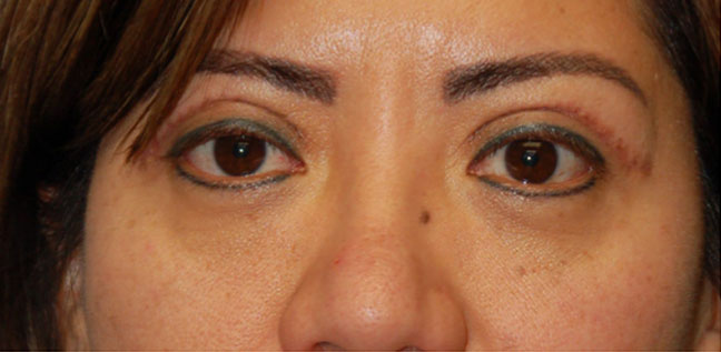 BLEPHAROPLASTY