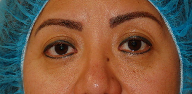 BLEPHAROPLASTY