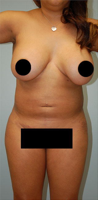 Laser Liposuction